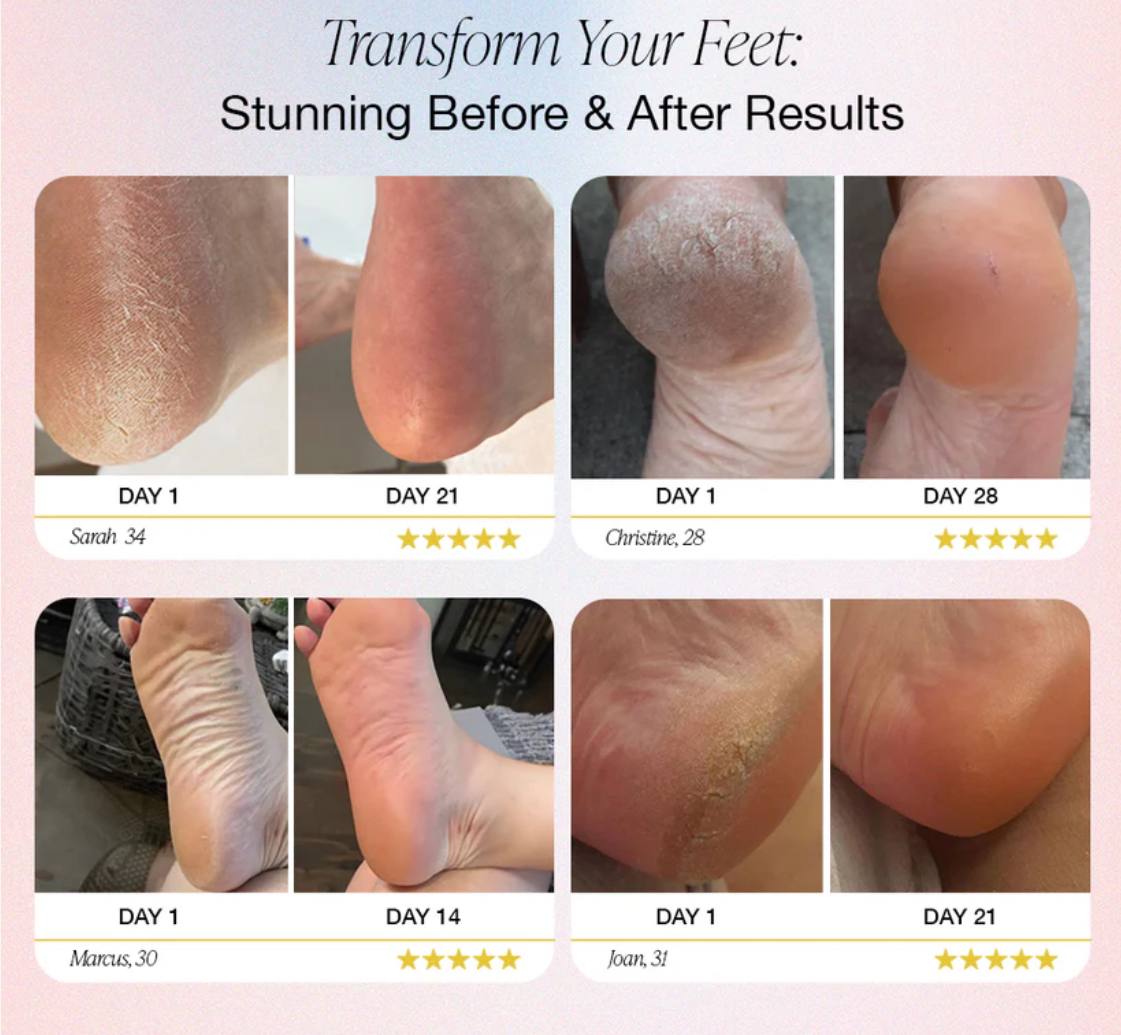 Electric Foot Callus Remover